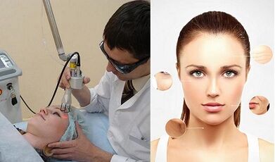 Cómo se realiza el rejuvenecimiento cutáneo con láser